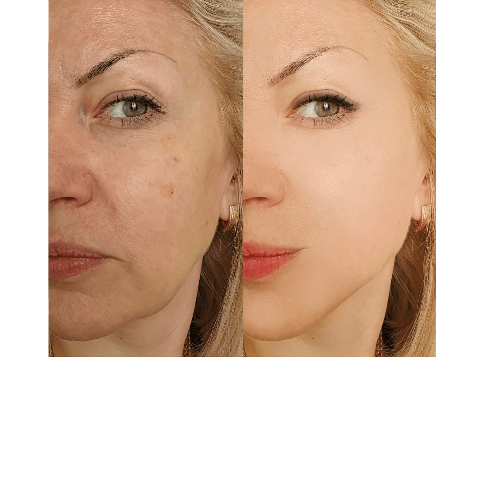 RF Microneedling 